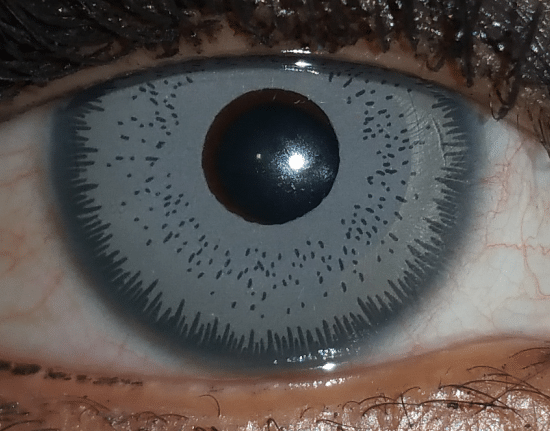 جراحة تغيير لون العين هل هي آمنة؟